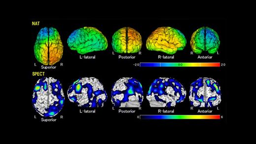 脳機能検査(NAT)での 脳機能の画像