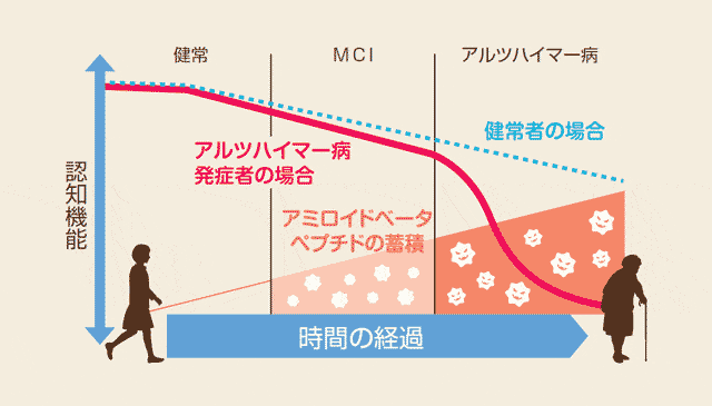 アルツハイマー発症までの経緯のグラフ